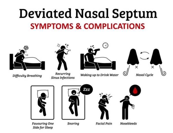 Deviated Septum Anatomy What causes a deviated septum