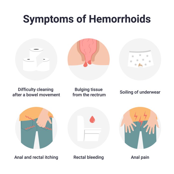 Hemorrhoids signs symptoms and complications