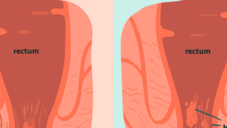 Hemorrhoids signs symptoms and complications